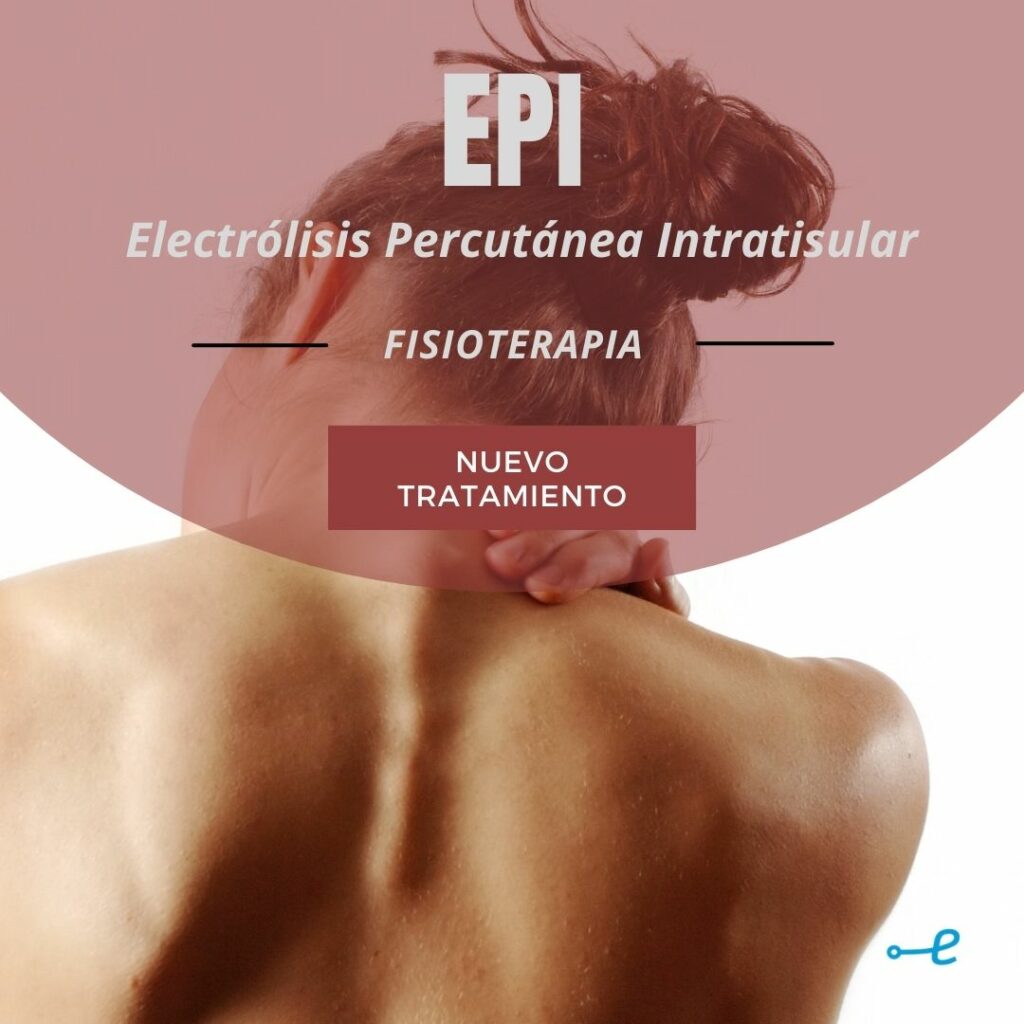 epi, fisioterapia, tratamiento